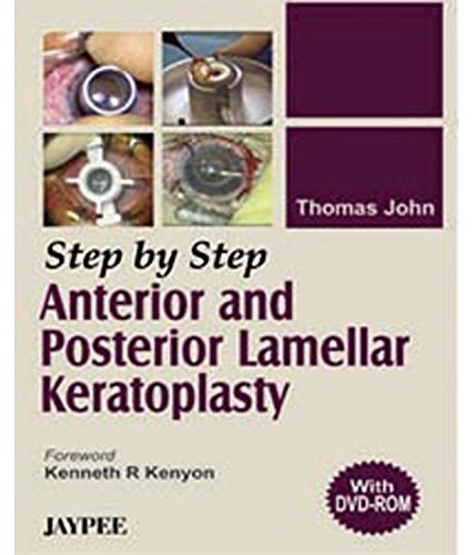 step-by-step-anterior-and-posterior-lamellar-keratoplastywith-dvd