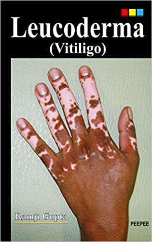 leucoderma-vitiligo