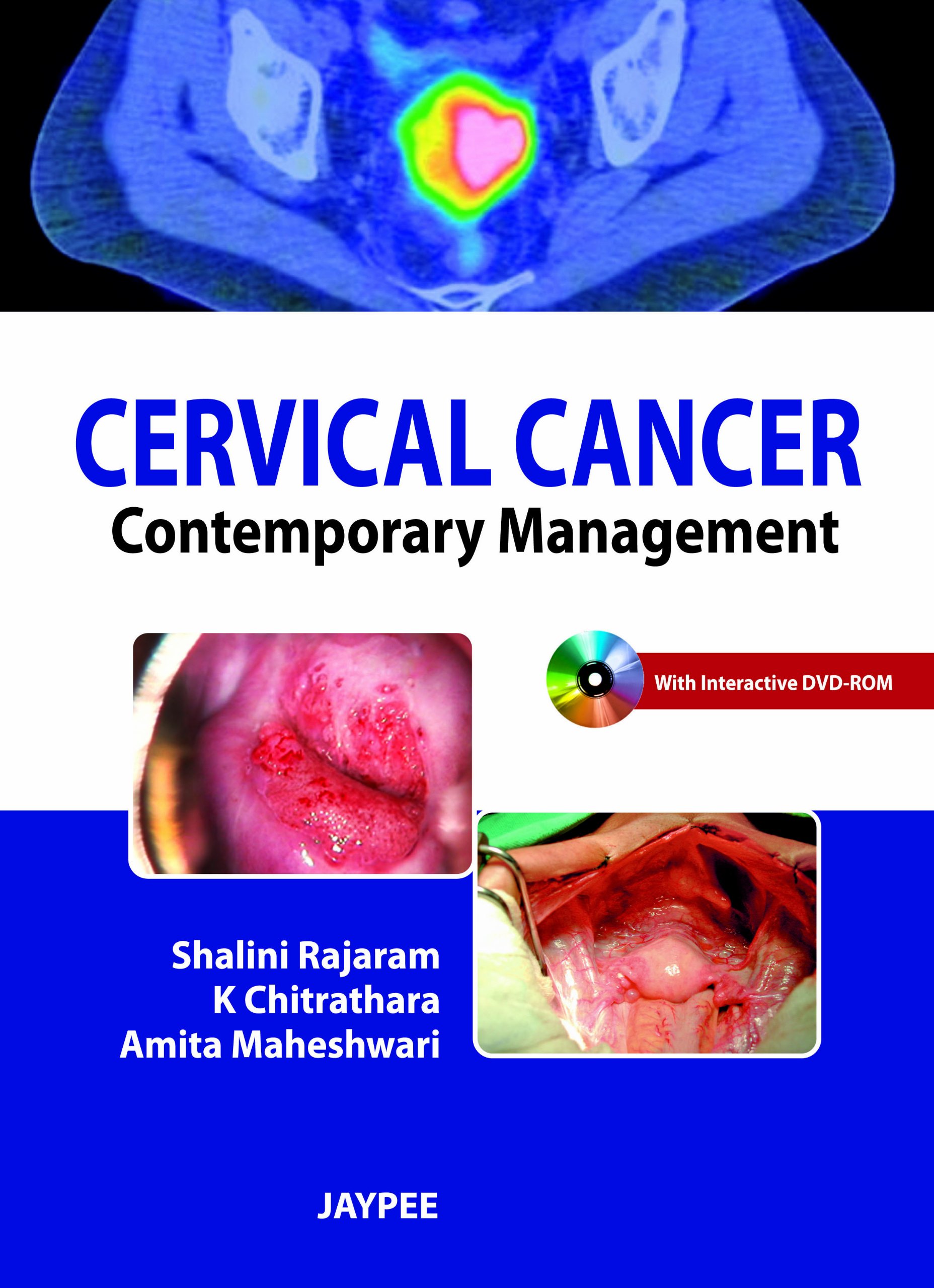 cervical-cancer-contemporary-management-with-dvd-rom