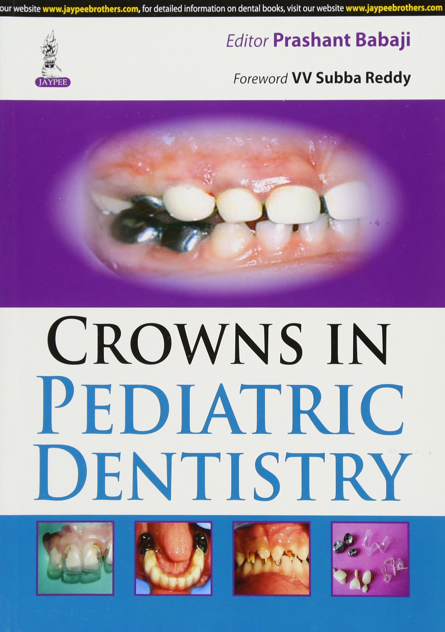 crowns-in-pediatric-dentistry